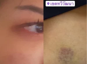 Woman Allegedly Attacked in Chonburi by Boyfriend who is an MP from the Move Forward Party
