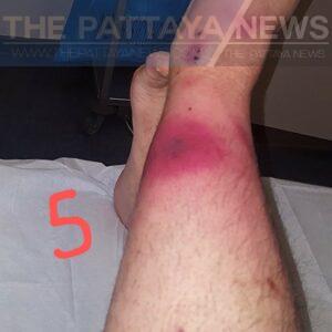 Medical Bytes Number 97: Legless in Thailand