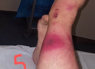 Medical Bytes Number 97: Legless in Thailand