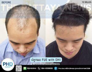 Tired of Being Bald or Losing Your Hair in Pattaya? PHD Clinic Pattaya is Here to Help!
