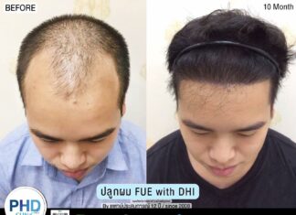 Tired of Being Bald or Losing Your Hair in Pattaya? PHD Clinic Pattaya is Here to Help!