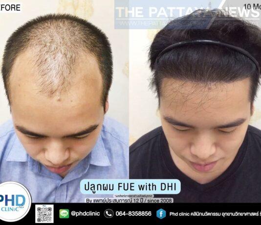 Tired of Being Bald or Losing Your Hair in Pattaya? PHD Clinic Pattaya is Here to Help!