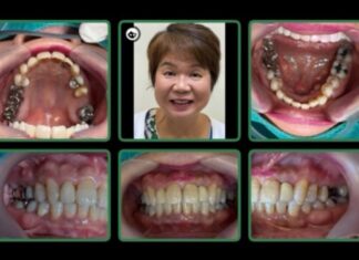 Возраст — это всего лишь цифра: ортодонтия на любом этапе жизни с Miradent Pattaya