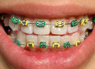Girls in Thailand are Wearing Braces as a Fashion Accessory but Here is Why Doctors are Sounding the Alarm